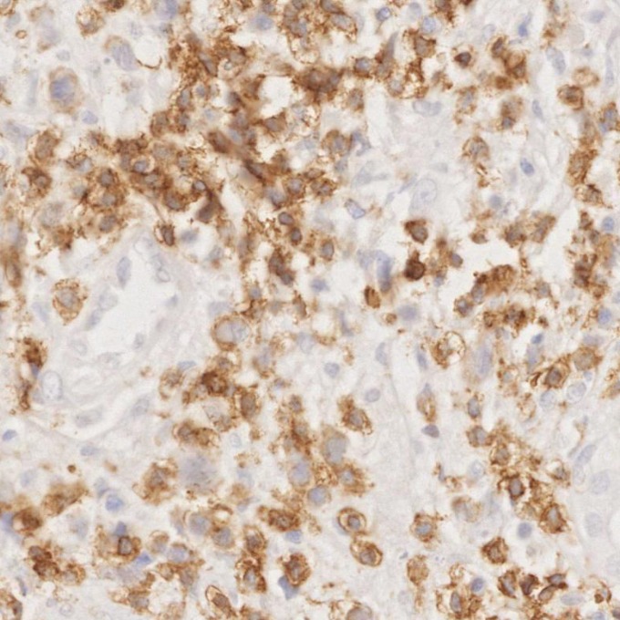 IHC staining of human lymphoma using 81324-1-RR IHC staining of human lymphoma using 81324-1-RR