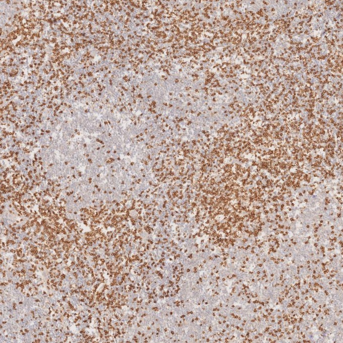 IHC staining of human lymphoma using 81324-1-RR IHC staining of human lymphoma using 81324-1-RR
