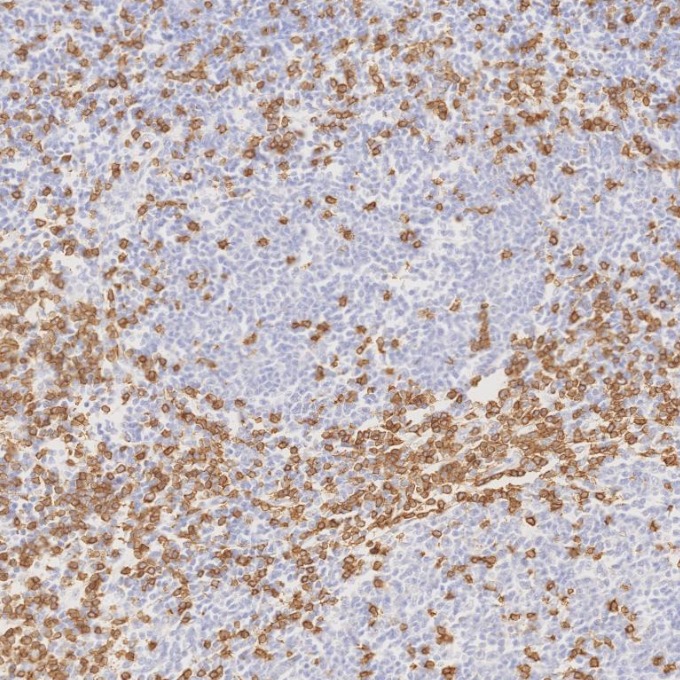 IHC staining of human lymphoma using 81324-1-RR IHC staining of human lymphoma using 81324-1-RR
