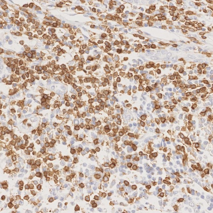 IHC staining of human lymphoma using 81324-1-RR IHC staining of human lymphoma using 81324-1-RR