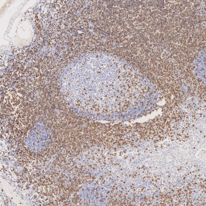 IHC staining of human tonsillitis using 81324-1-RR IHC staining of human tonsillitis using 81324-1-RR