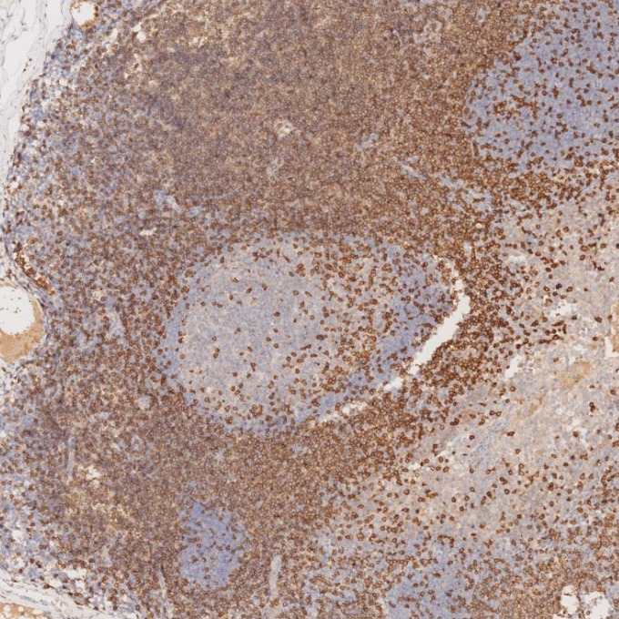 IHC staining of human tonsillitis using 81324-1-RR IHC staining of human tonsillitis using 81324-1-RR
