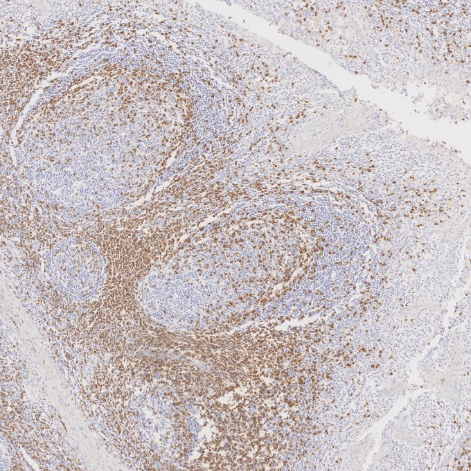 IHC staining of human tonsillitis using 81324-1-RR IHC staining of human tonsillitis using 81324-1-RR