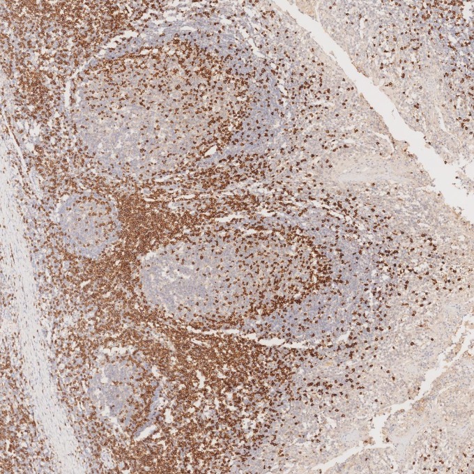 IHC staining of human tonsillitis using 81324-1-RR IHC staining of human tonsillitis using 81324-1-RR