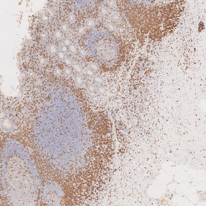 IHC staining of human appendicitis using 81324-1-RR IHC staining of human appendicitis using 81324-1-RR