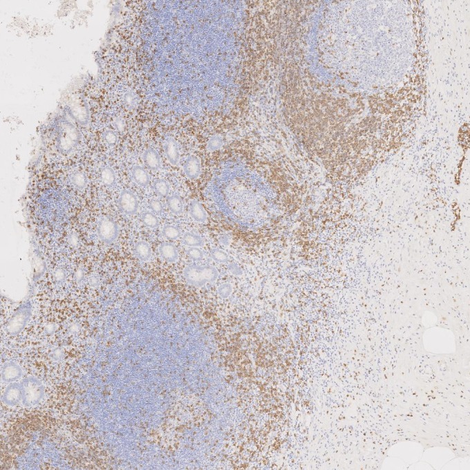 IHC staining of human appendicitis using 81324-1-RR IHC staining of human appendicitis using 81324-1-RR