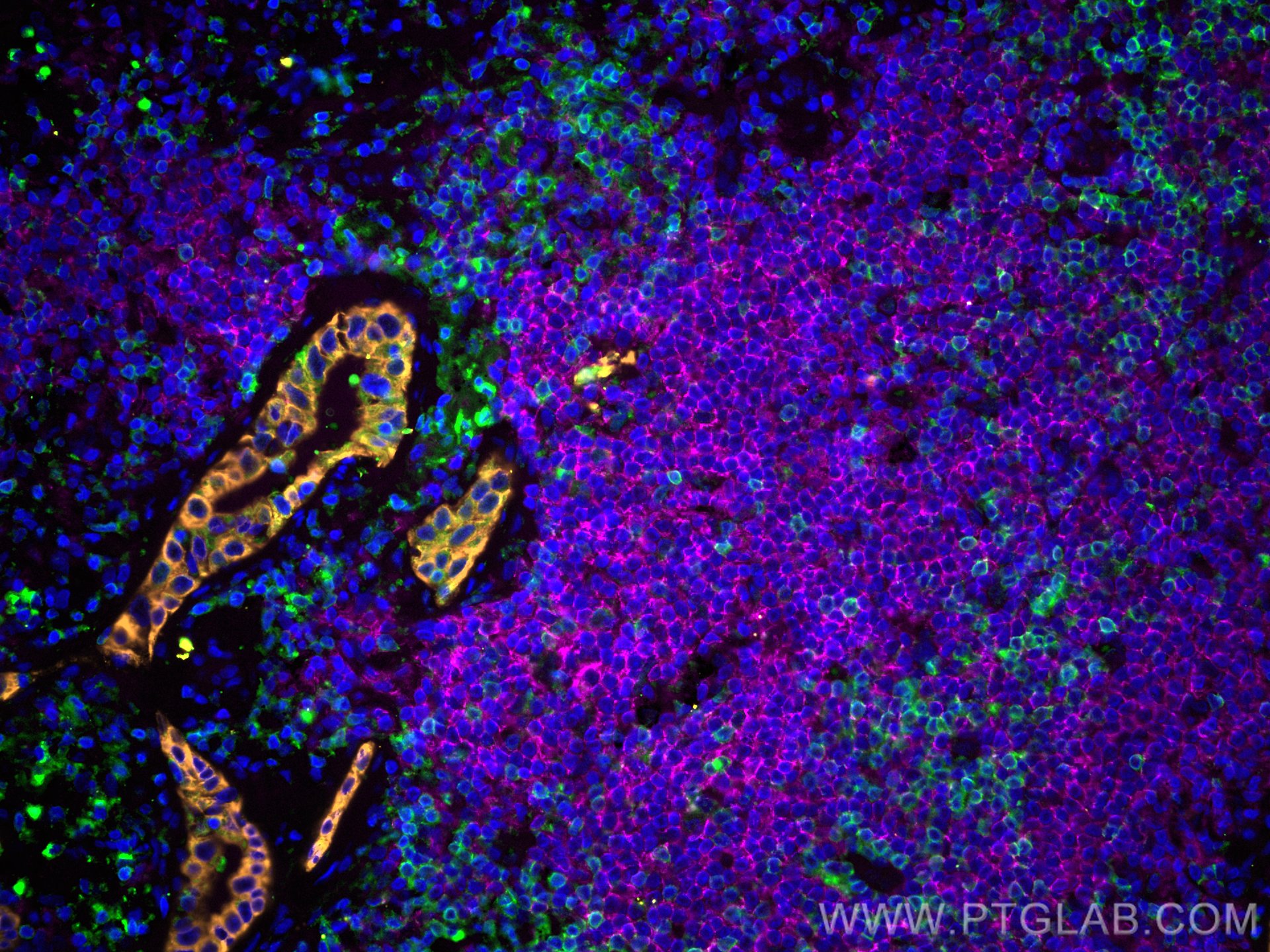 IF Staining of human lung cancer using CL488-60181