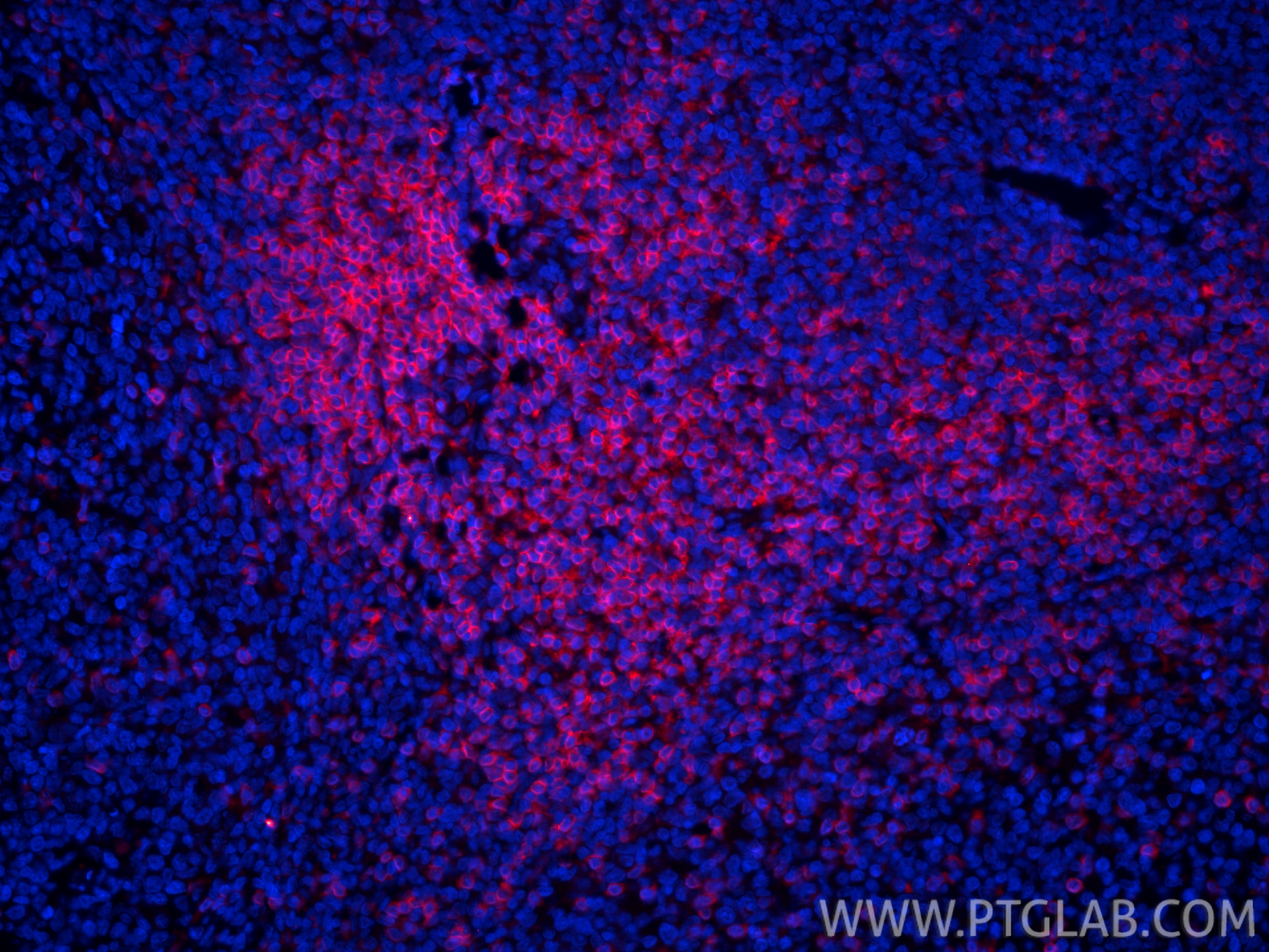 IF Staining of human tonsillitis using CL594-81324 IF Staining of human tonsillitis using CL594-81324