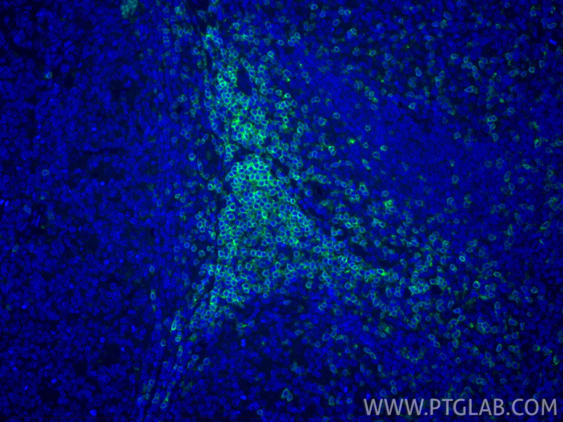 Immunofluorescent analysis of (4% PFA) fixed paraffin-embedded human tonsillitis tissue using CD3 Delta antibody (<a class='green' href='/productredirect?CatalogNo=84214-4-RR' target='_blank'>84214-4-RR</a>, Clone: 241523H2 ) at dilution of 1:200 and CoraLite®488-Conjugated Goat Anti-Rabbit IgG(H+L) (<a class='green' href='/productredirect?CatalogNo=SA00013-2' target='_blank'>SA00013-2</a>). Heat mediated antigen retrieval with Tris-EDTA buffer (pH 9.0). This data was developed using the same antibody clone with 84214-4-PBS in a different storage buffer formulation. IF Staining of human tonsillitis using 84214-4-RR (same clone as 84214-4-PBS)