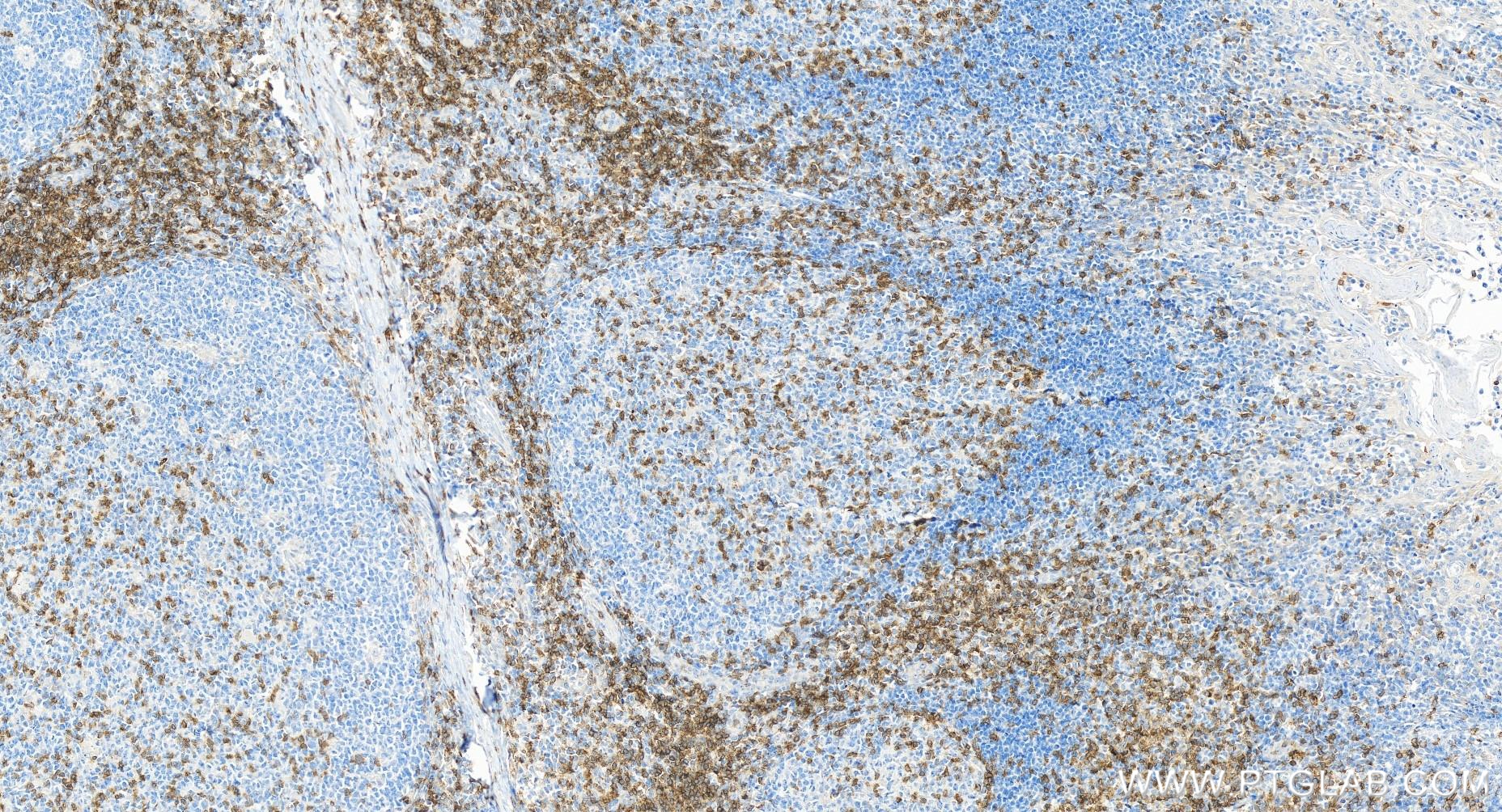 IHC staining of human tonsillitis using 84836-1-RR (same clone as 84836-1-PBS)