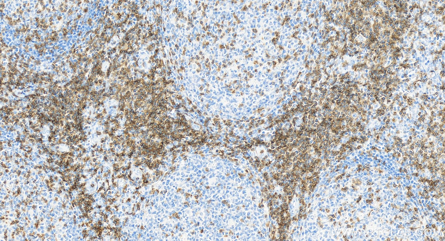 IHC staining of human tonsillitis using 84836-2-RR