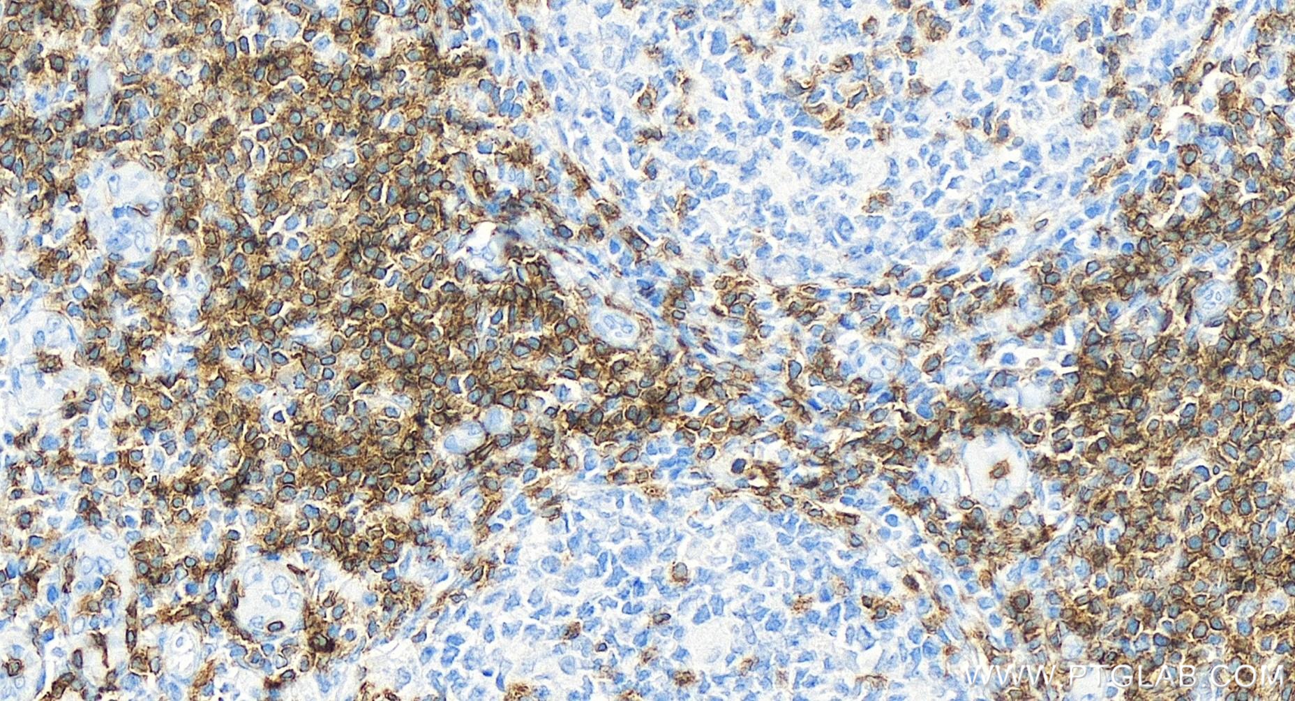 IHC staining of human tonsillitis using 84836-2-RR