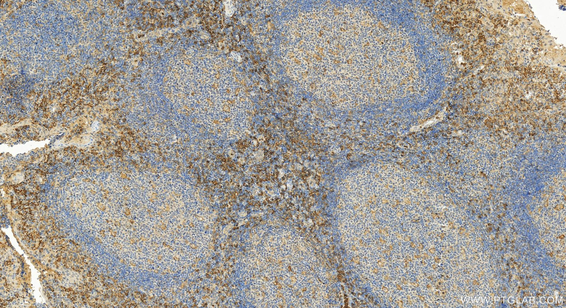 IHC staining of human tonsillitis using 32141-1-AP
