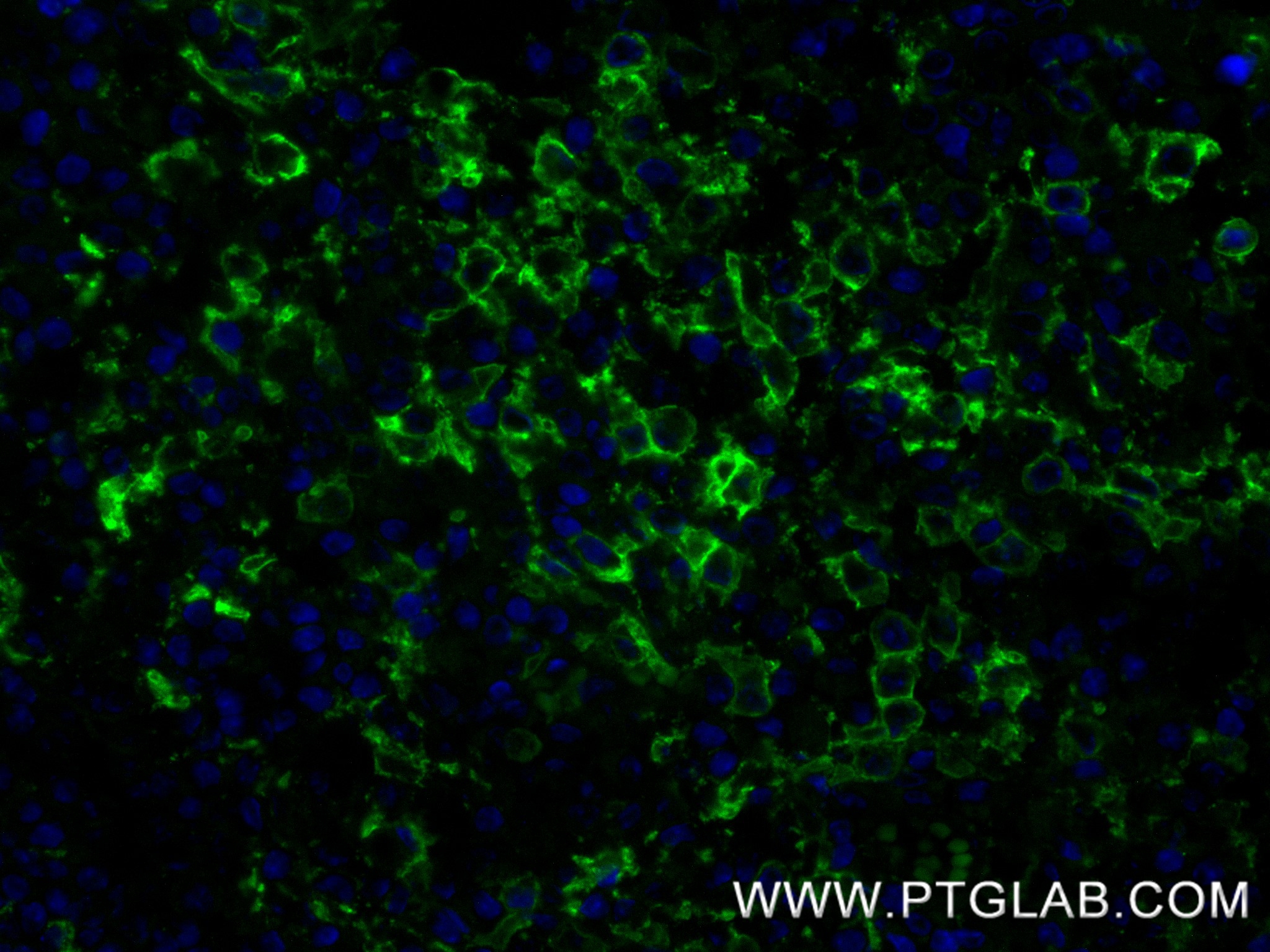 IF Staining of human tonsillitis using 87497-1-RR IF Staining of human tonsillitis using 87497-1-RR
