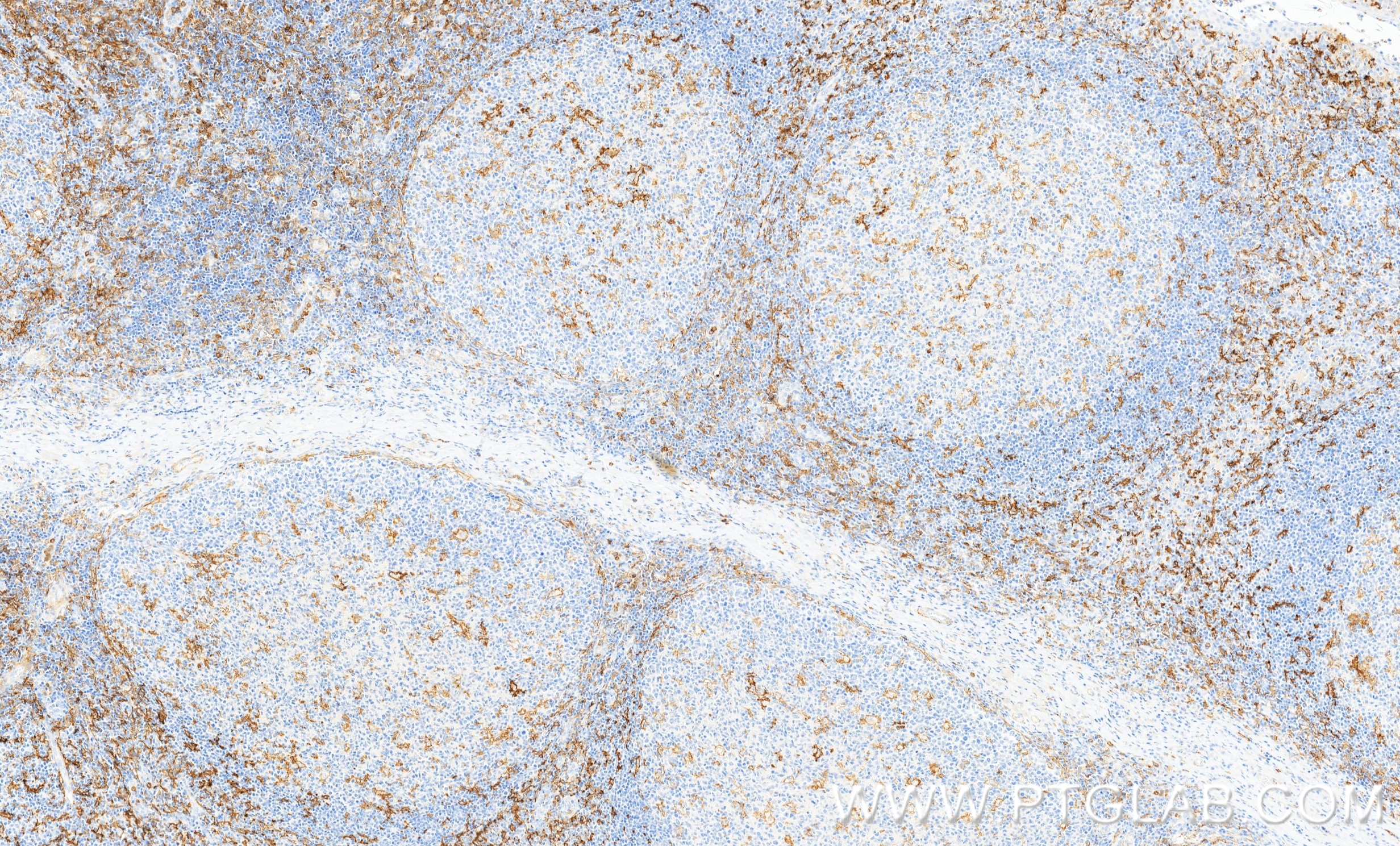 IHC staining of human tonsillitis using 87497-1-RR