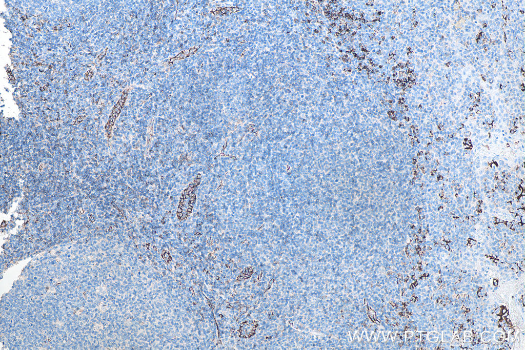 IHC staining of human tonsillitis using 66065-2-Ig