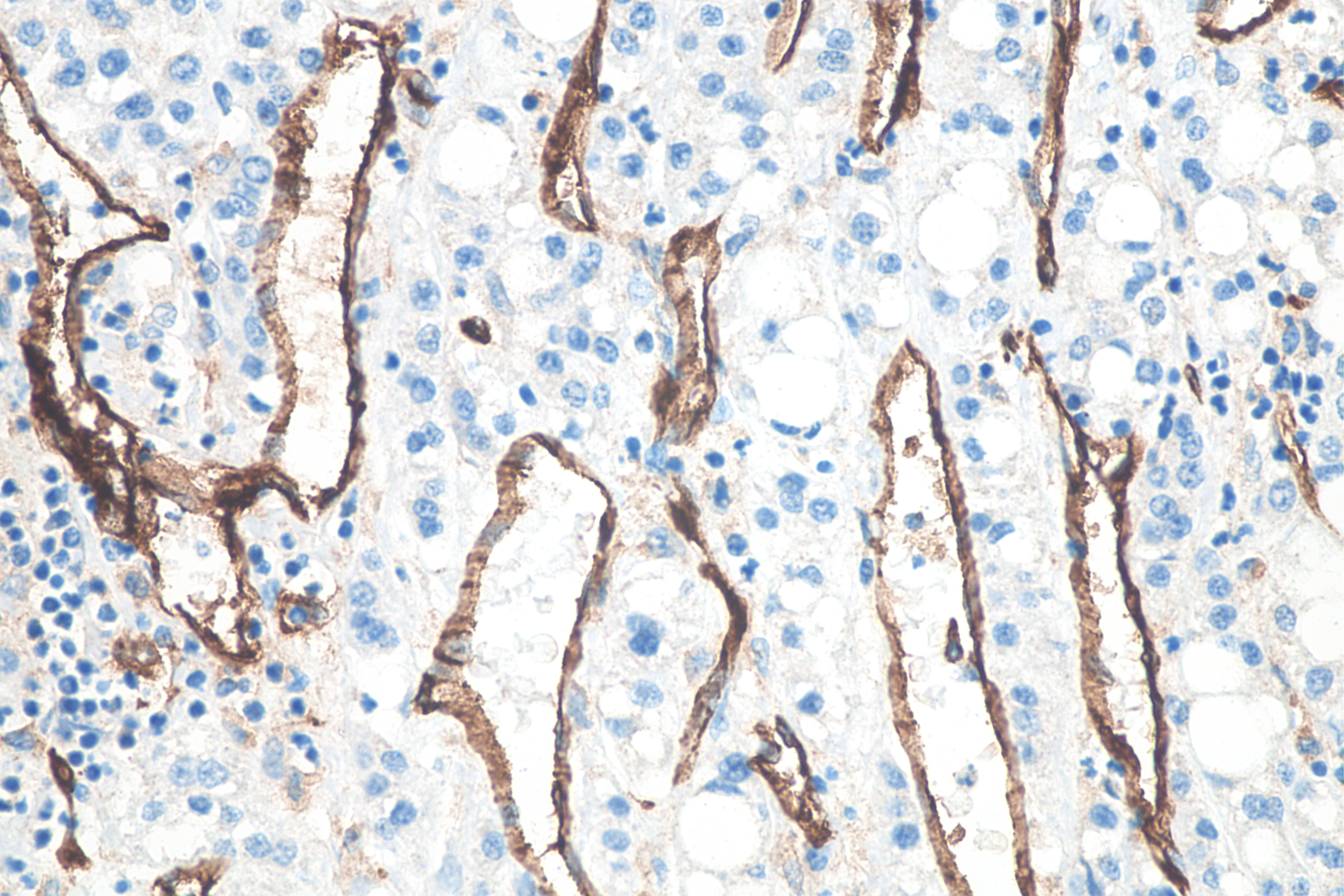 IHC staining of human liver cancer using 66065-2-Ig (same clone as 66065-2-PBS)