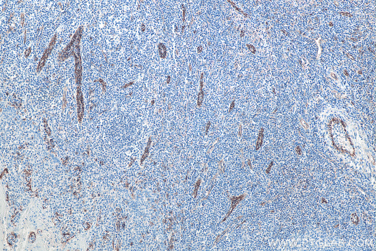IHC staining of human tonsillitis using 66065-2-Ig