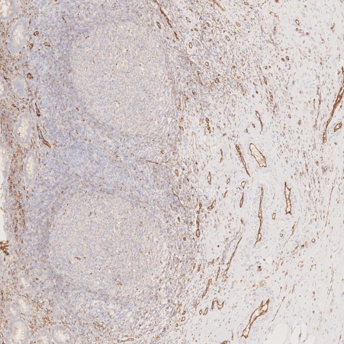 IHC staining of human appendicitis using 66065-2-Ig