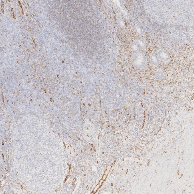 IHC staining of human appendicitis using 66065-2-Ig