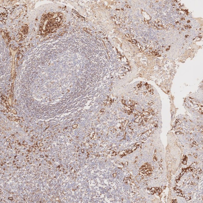 IHC staining of human tonsillitis using 66065-2-Ig