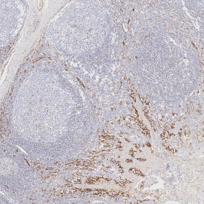 IHC staining of human tonsillitis using 66065-2-Ig