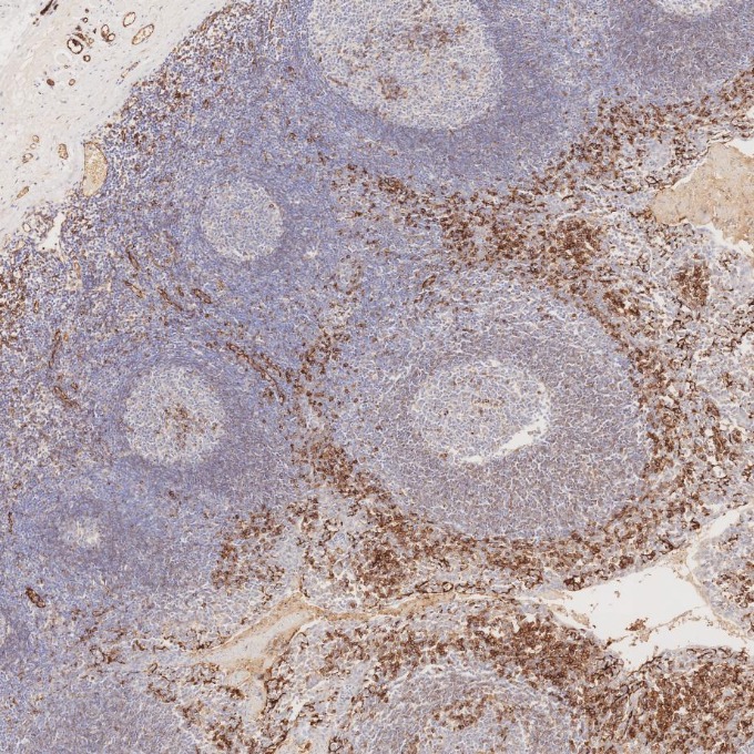 IHC staining of human tonsillitis using 66065-2-Ig