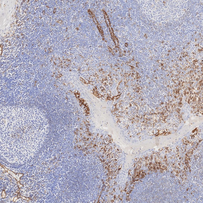 IHC staining of human tonsillitis using 66065-2-Ig