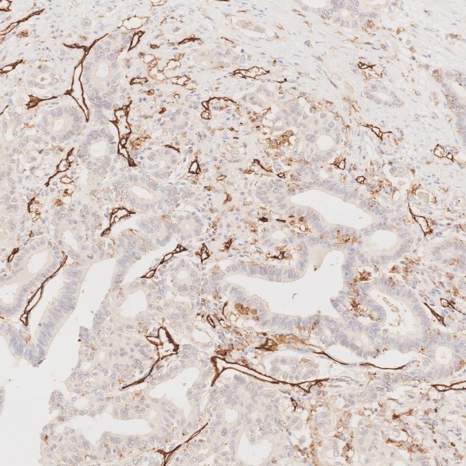 IHC staining of human pancreas cancer using 66065-2-Ig