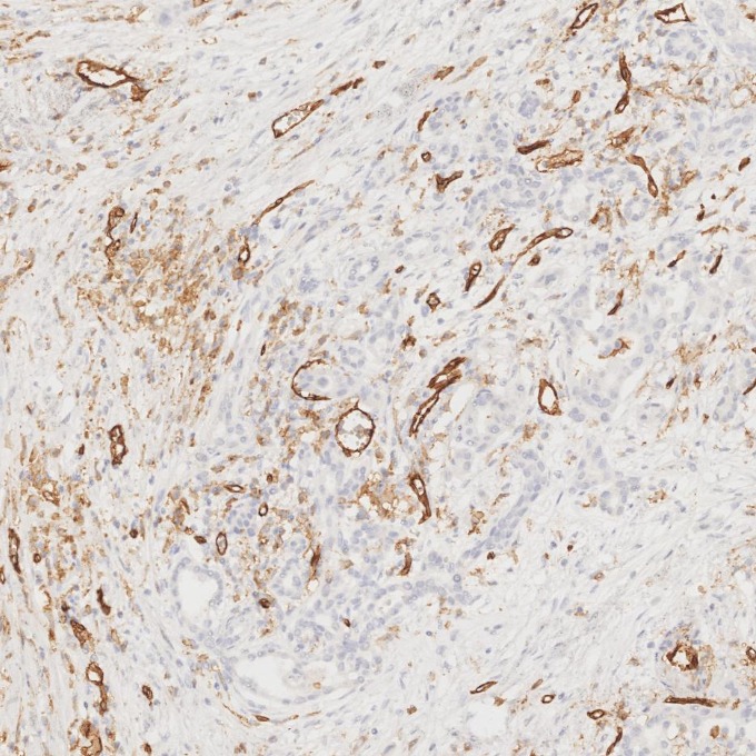 IHC staining of human pancreas cancer using 66065-2-Ig