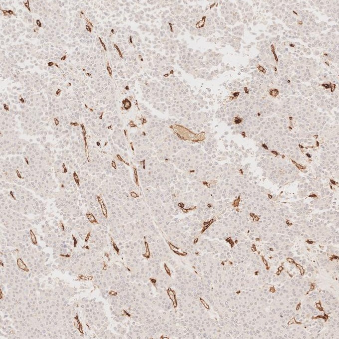 IHC staining of human liver cancer using 66065-2-Ig