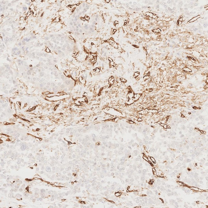 IHC staining of human liver cancer using 66065-2-Ig