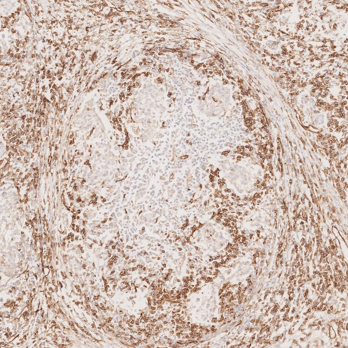 IHC staining of human stomach cancer using 66065-2-Ig