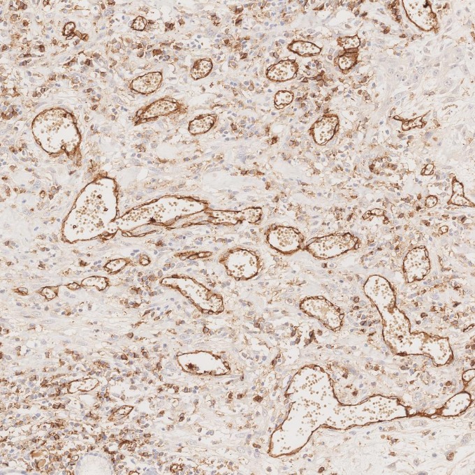 IHC staining of human oesophagus cancer using 66065-2-Ig