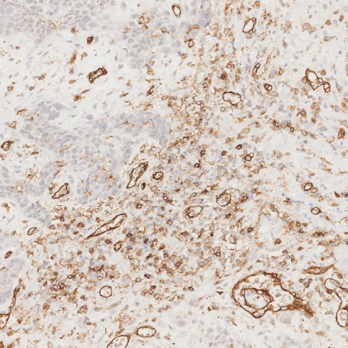IHC staining of human oesophagus cancer using 66065-2-Ig