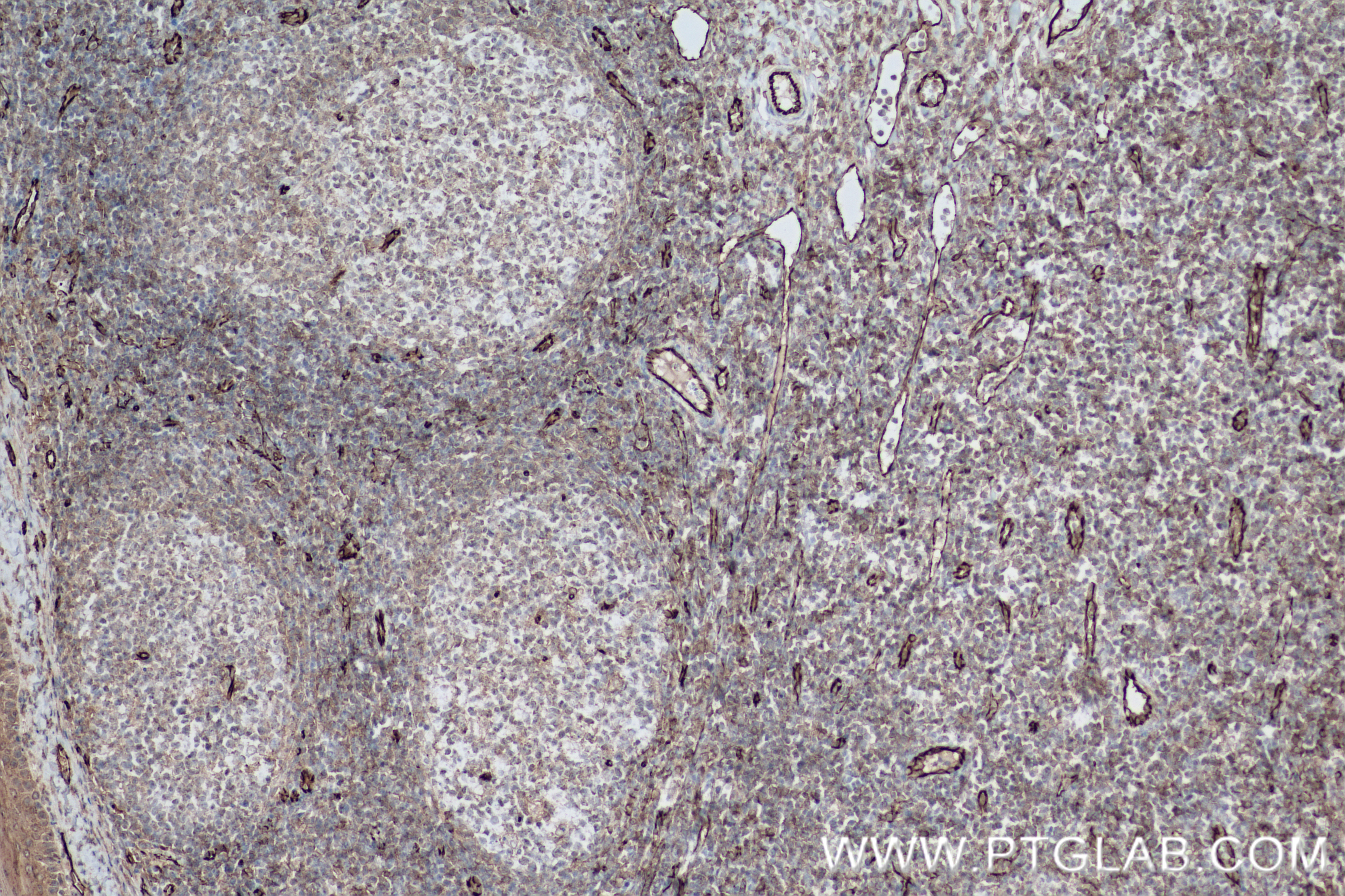 IHC staining of human tonsillitis using 80530-1-RR
