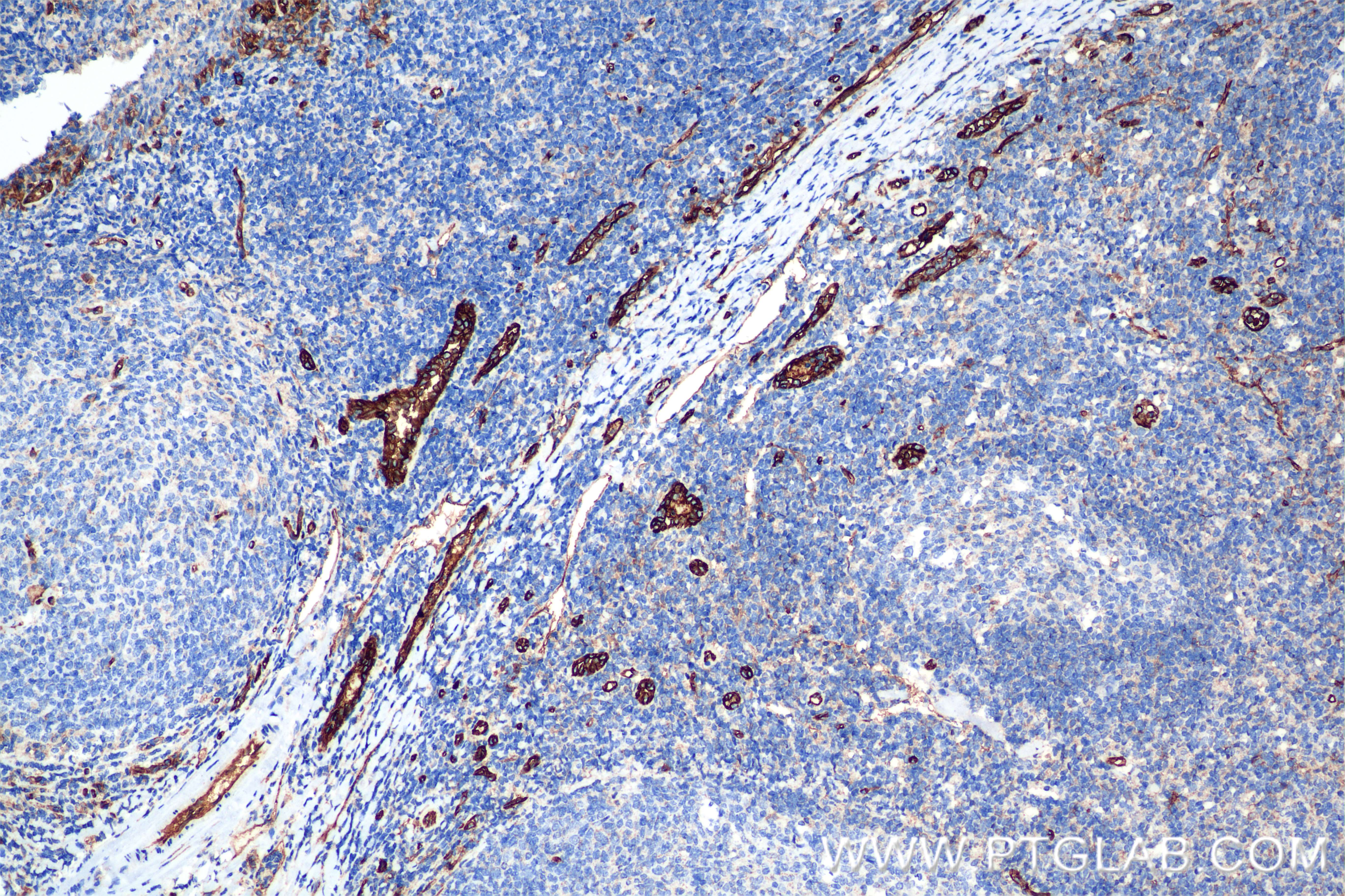 IHC staining of human tonsillitis using 80530-1-RR (same clone as 80530-1-PBS)