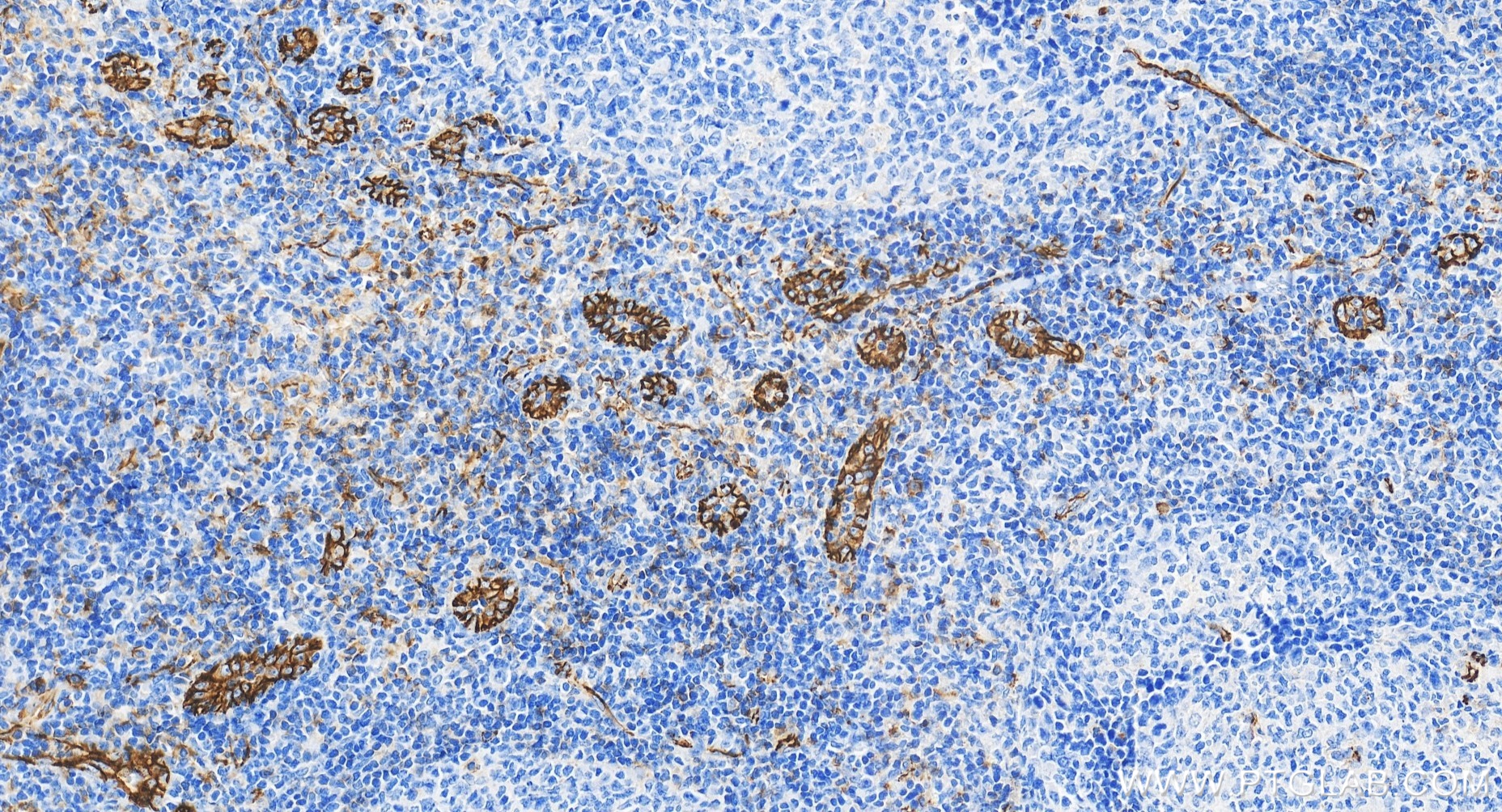 IHC staining of human tonsillitis using 80773-4-RR