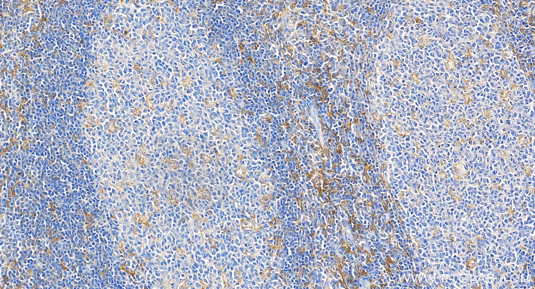 IHC staining of human tonsillitis using 84341-6-RR