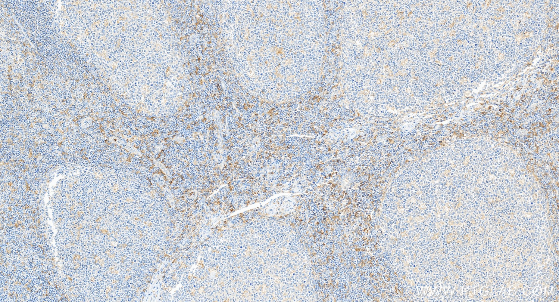 IHC staining of human tonsillitis using 84341-6-RR