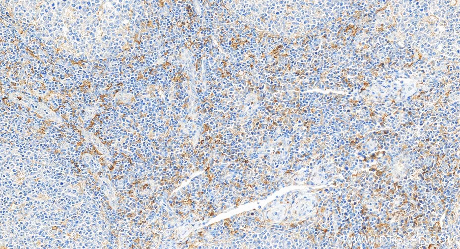 IHC staining of human tonsillitis using 84341-6-RR