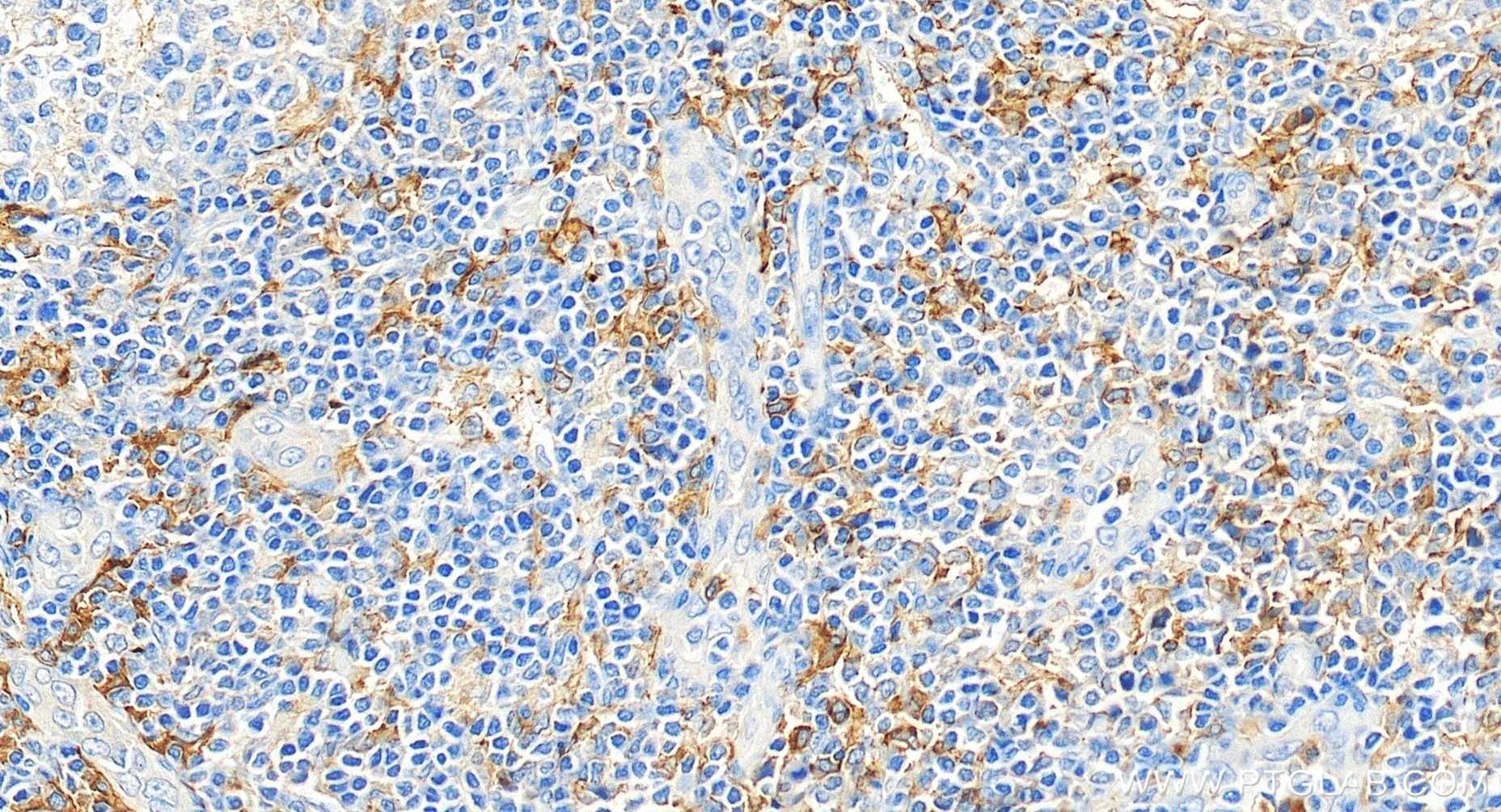 IHC staining of human tonsillitis using 84341-6-RR