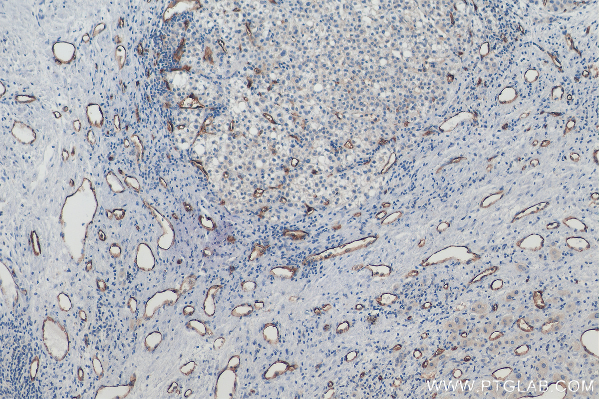 IHC staining of human liver cancer using 60180-1-Ig (same clone as 60180-1-PBS)