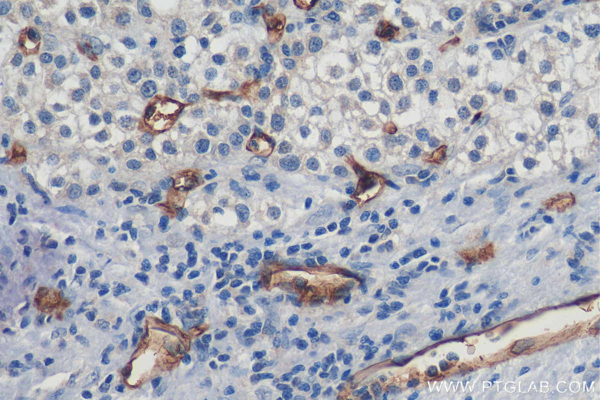IHC staining of human liver cancer using 60180-1-Ig (same clone as 60180-1-PBS)
