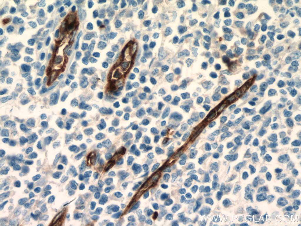 IHC staining of human tonsillitis using 60180-2-Ig