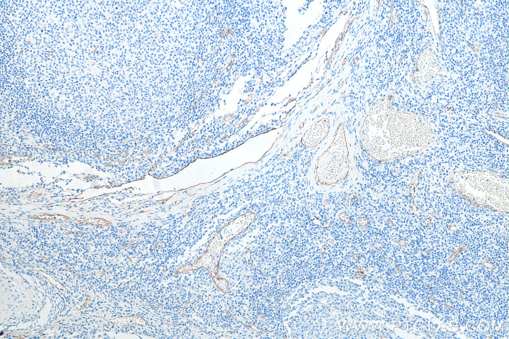 IHC staining of human tonsillitis using 60180-2-Ig IHC staining of human tonsillitis using 60180-2-Ig