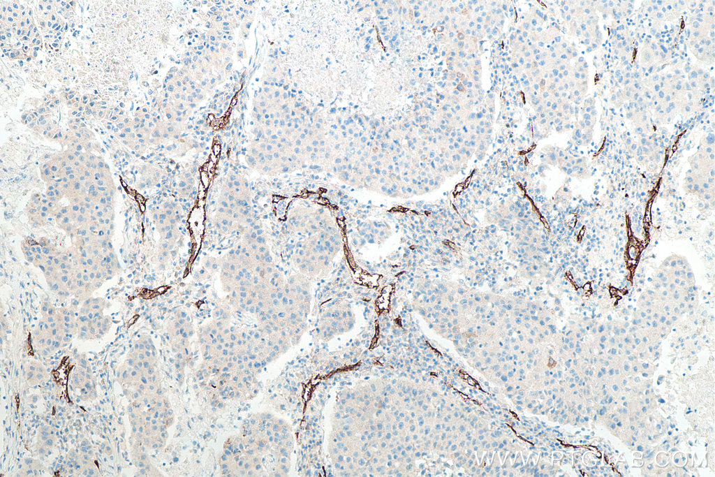 IHC staining of human breast cancer using 60180-2-Ig IHC staining of human breast cancer using 60180-2-Ig