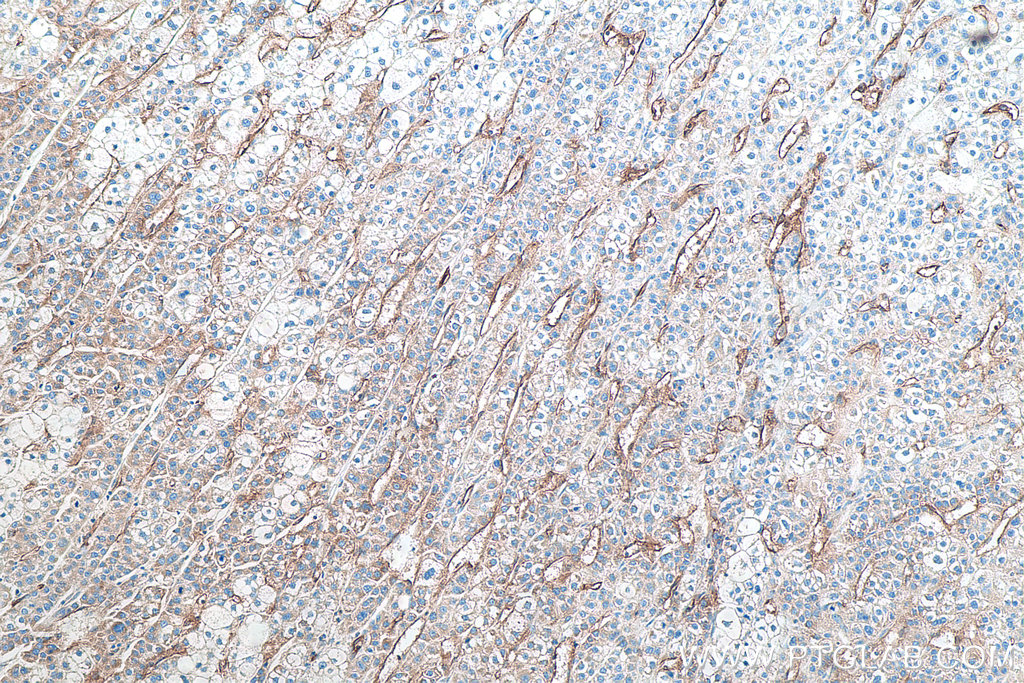 IHC staining of human liver cancer using 60180-2-Ig IHC staining of human liver cancer using 60180-2-Ig