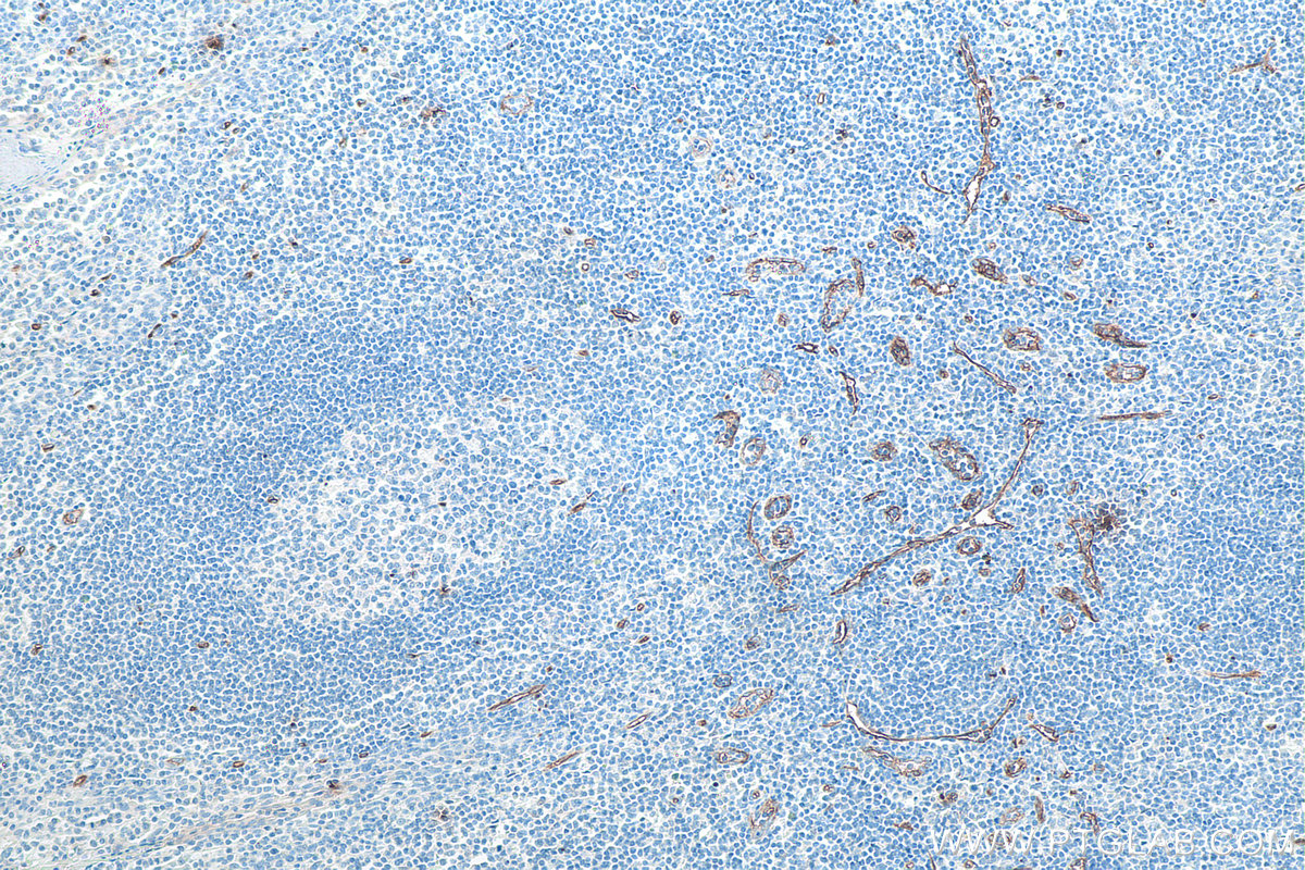 IHC staining of human tonsillitis using 60180-2-Ig IHC staining of human tonsillitis using 60180-2-Ig