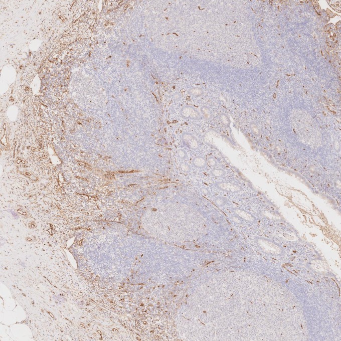 IHC staining of human appendicitis using 60180-2-Ig
